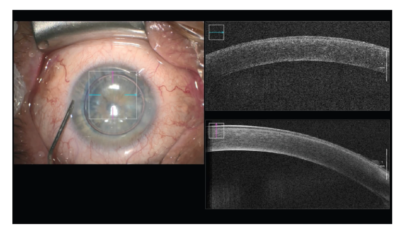 Kontrola přiložení lamely ke stromatu rohovky po injekci bubliny vzduchu
v závěru DMEK (Descemet Membrane Endothelial Keratoplasty)