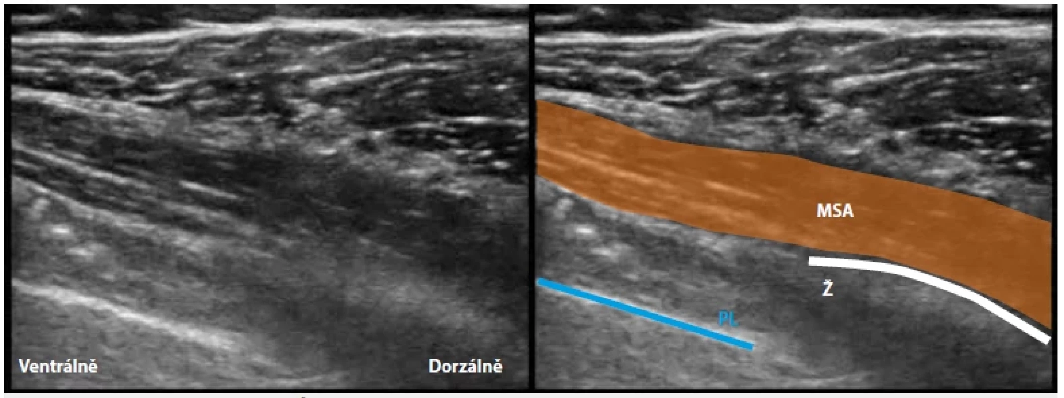Hluboký a povrchový Serratus anterior plane block