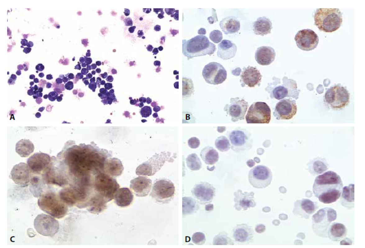 Ilustrační případ 4. (A) Nádorová pleocytóza. MGG 200x. (B) Pozitivita cytokeratinů. CKAE, 400x. (C) Pozitivita estrogenních receptorů.
600x. (D) Slabá pozitivita TTF1. 400x.