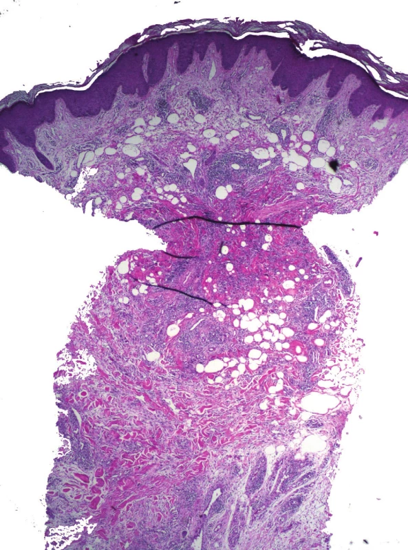 Deformace průbojníkové excize pinzetou a pseudolipomatosis
cutis – mnohočetné vakuoly v koriu