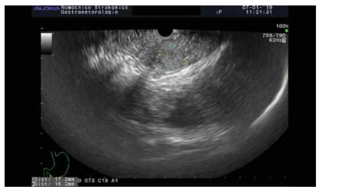 Solidní pseudopapilární neoplazie.<br>
Fig. 3. Solid pseudopapillary neoplasia.