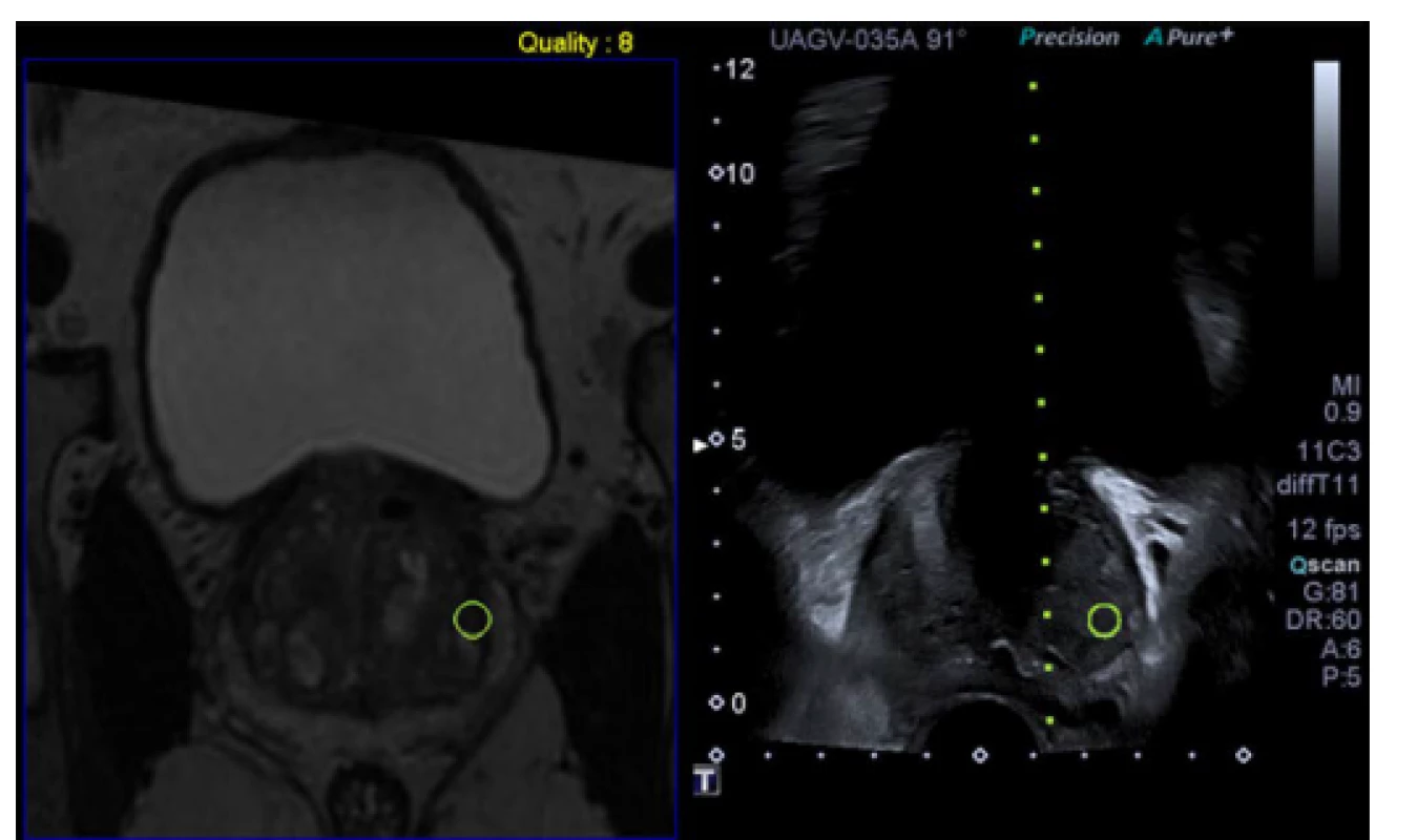 Softwarová mpMRI/US fúzní biopsie. Archiv autora<br>
Pic. 2. Software mpMRI guided fusion biopsy. Author’s archive