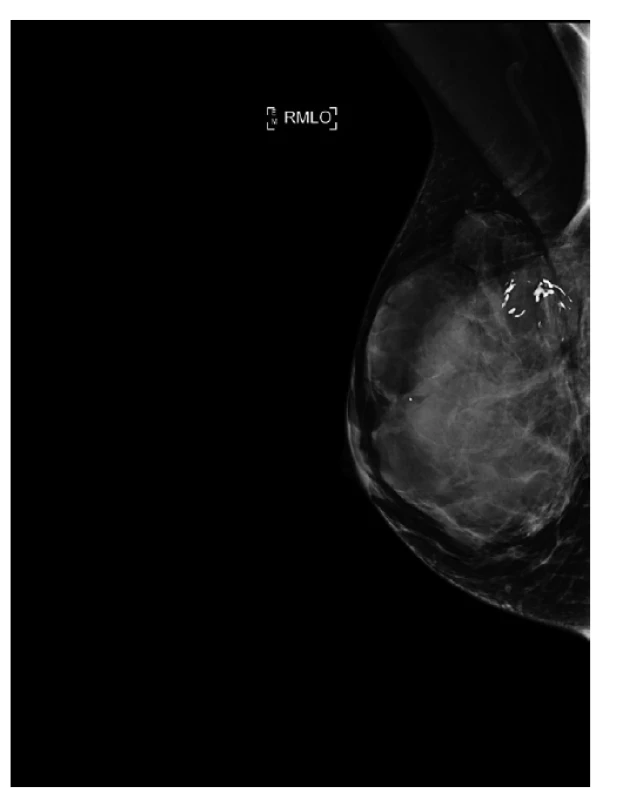Mamograf, šikmá projekce, primární tumor, velikost
7cm, fixovaný ke kůži.<br>
Fig. 1: Mammogram, mediolateral oblique projection,
primary tumor, size 7cm, fixed to the skin.