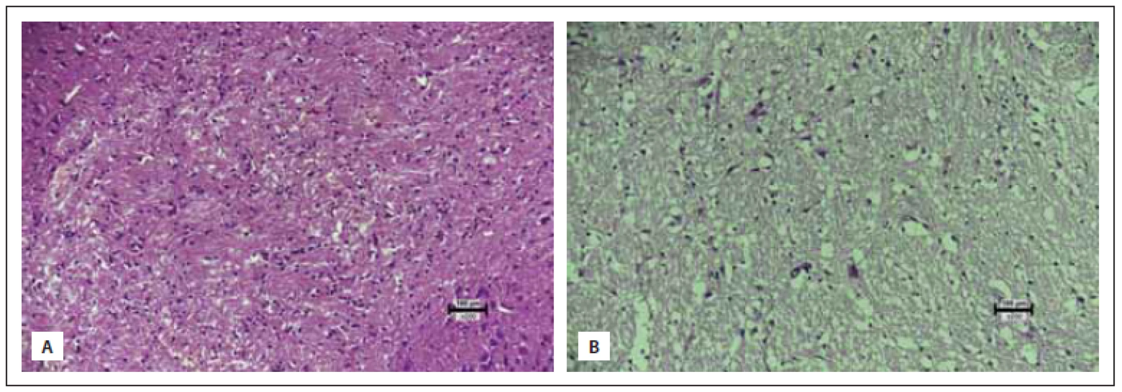 (A) Small groups of lymphoid cells in the brain tissue of the trauma group (score 0). (B) Few dispersed lymphoid cells within the
bain tissue of the sumatriptan group (score 1) (hematoxylin eosin 200×). <br> 
Obr. 3 (A) Skupinky lymfoidních buněk v mozkové tkáni ve skupině s traumatem (skóre 0). (B) Několik dispergovaných lymfoidních buněk
v mozkové tkáni ve skupině na sumatriptanu (skóre 1) (hematoxylin-eozin 200×).