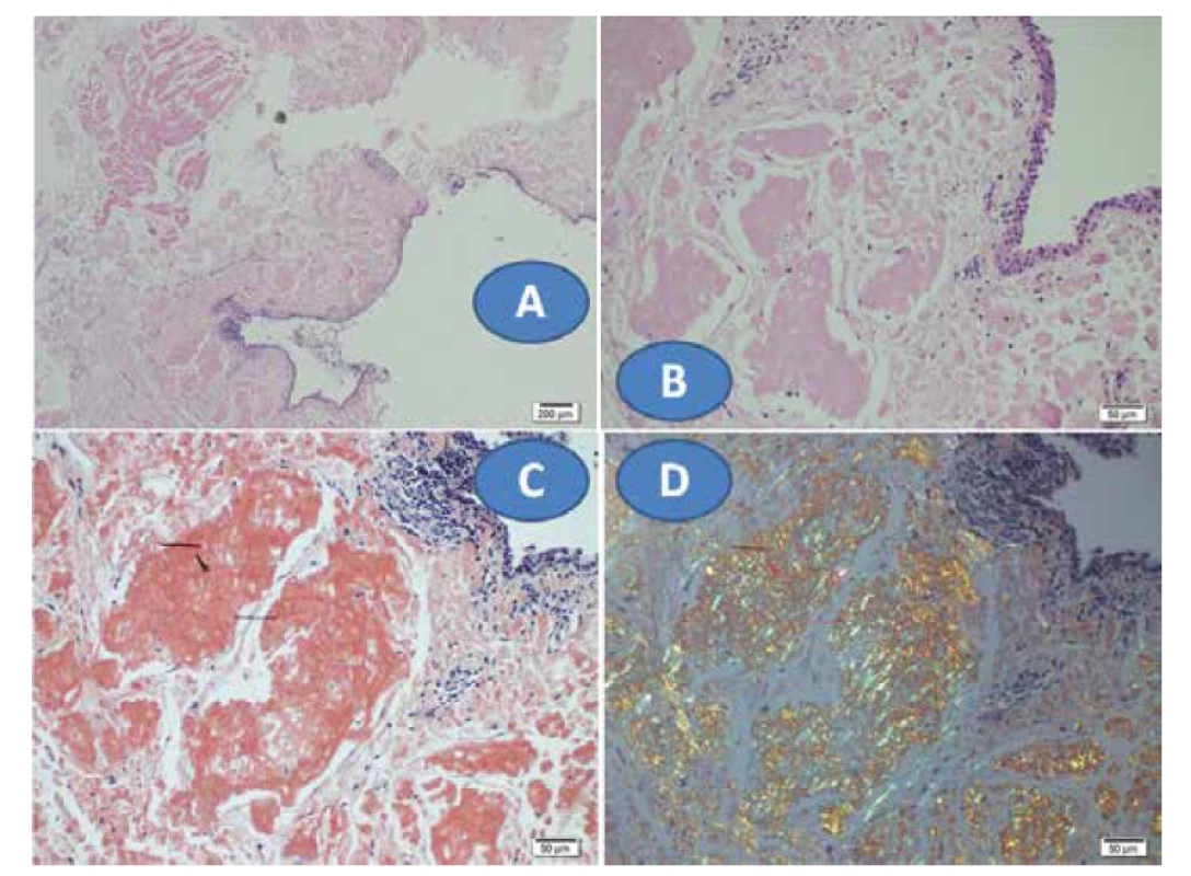 Depozita amyloidu – eosinofilní hmoty ve víčku, HE, zvětšení 40x (A) a zvětšení 200x (B), pozitivní
barvení Kongo červení, zvětšení 200x (C), barvení Kongo červení v polarizovaném světle, zvětšení
200x (D)