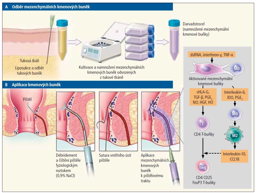 Schéma přípravy a aplikace MSC. [Upraveno podle: Baumgart DC, Le Berre C. Newer biologic and small-molecule therapies for inflammatory bowel disease.<br>
N Engl J Med 2021;385(14):1302–1315. doi: 10.1056/NEJMra1907607. PMID: 34587387.]