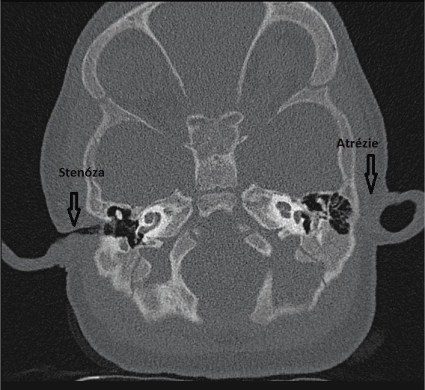Stenóza a atrézie zvukovodu.<br>
Fig. 1. Stenosis and atresia of the external auditory canal.
