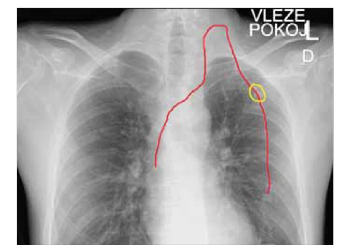RTG hrudníku u pacienta po alternativní implantaci
periferně zaváděný centrální katetr cestou levé v. jugularis
s tunelizací podkožím na hrudník do subklavikulární
oblasti, katetr pro zvýšení přehlednosti zvýrazněn
červenou barvou, žlutě zvýrazněna pozice výstupu
katetru z podkoží a umístění fi xačního systému.
