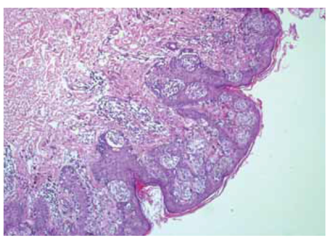 Superficiálně se šířící maligní melanom.<br>
Fig. 3. Superficially spreading melanoma.