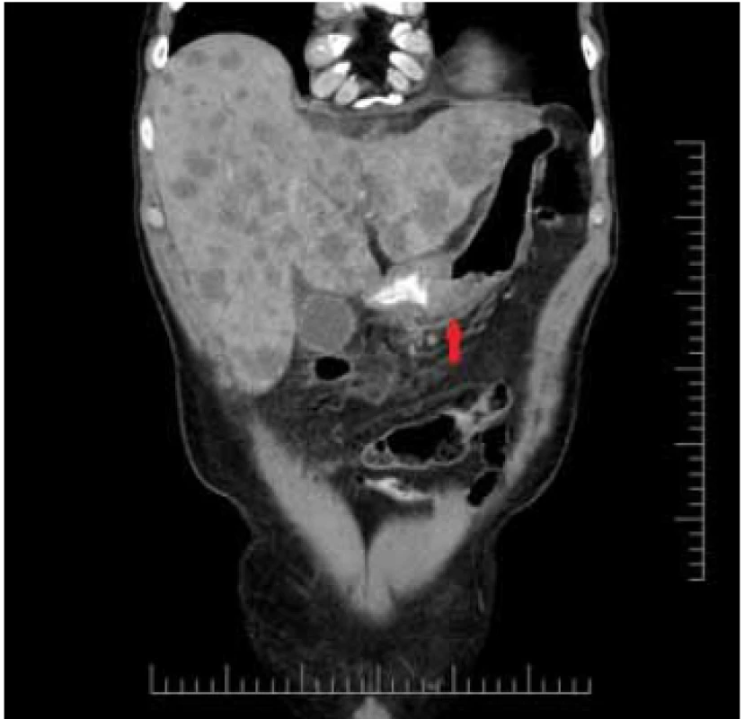 Liver metastases on the
right, pathologic lymph node on the
left.<br>
Obr. 3. Vpravo metastázy heparu, vľavo
patologická lymfatická uzlina.