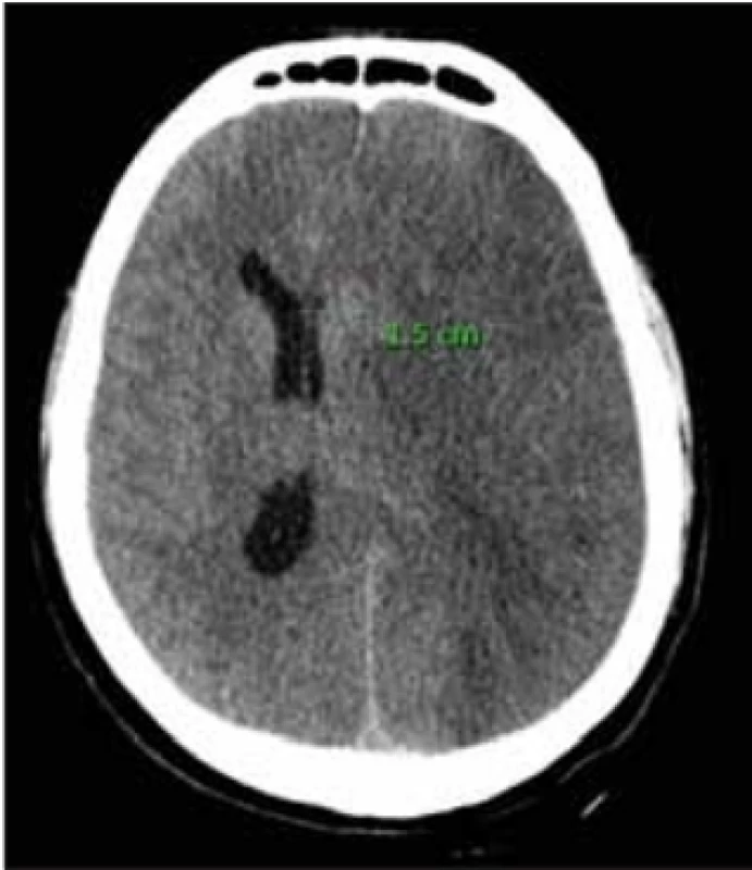  CT mozku s nálezem expanzivního
procesu levé hemisféry na podkladě maligního hemisferálního infarktu s přesunem středočárových struktur o 15 mm.<br>
Fig. 1. CT scan of the brain with the fi nding of the expansive process of the left
hemisphere caused by a malignant middle cerebral artery infarction; midline shift
15 mm.