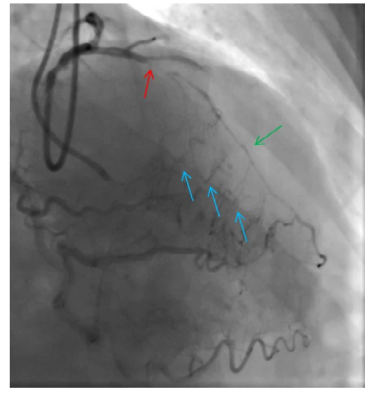 CTO ramus interventricularis anterior (RIA) – uzávěr má délku
pod 20 mm, je zřejmá proximální „cap“ uzávěru (červená šipka) a nejsou
přítomny zjevné kalcifikace (J-CTO 0); distální a střední segment RIA (zelená
šipka) se plní přes septální kolaterály z pravé věnčité tepny (modré šipky)