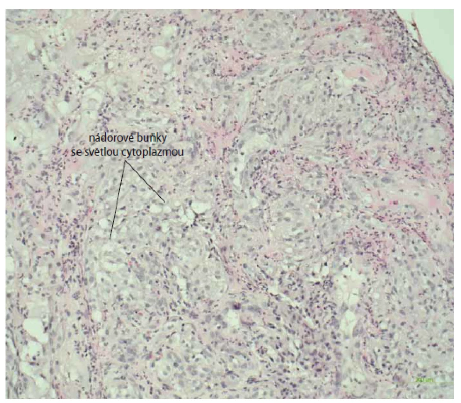 Histologický nález vredu duodena s infi ltráciou nádorových buniek
(metastáza karcinómu obličky), farbenie hematoxin-eozinom, zväčšenie 20×.<br>
Fig. 8. Histological image of a duodenal ulcer with infiltration of tumour cells
(metastasis of renal cell carcinoma), haematoxylin-eosin staining, magnification20?×.