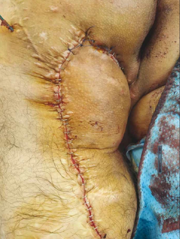 Defect covered by fasciocutaneous flap.<br>
Obr. 4. Defekt uzavřen fasciokutánním lalokem.