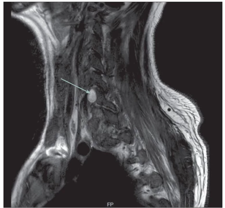 MR obraz likvorové pseudocysty na úrovni C6/7 vpravo (šipka). Tekutina v T2 skenech
hyperintenzní.<br>
Fig. 2. MR image of a liquor pseudocyst at C6/7 level on the right (arrow). Hyperintense
fluid in T2 scans.