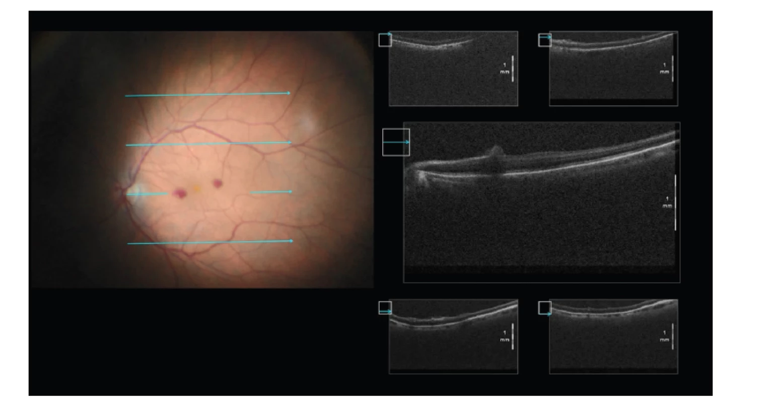 Ověření lokalizace hemorhagie v oblasti makulopapilárního svazku po peelingu
epiretinální membrány – nedošlo k natržení neuroretiny