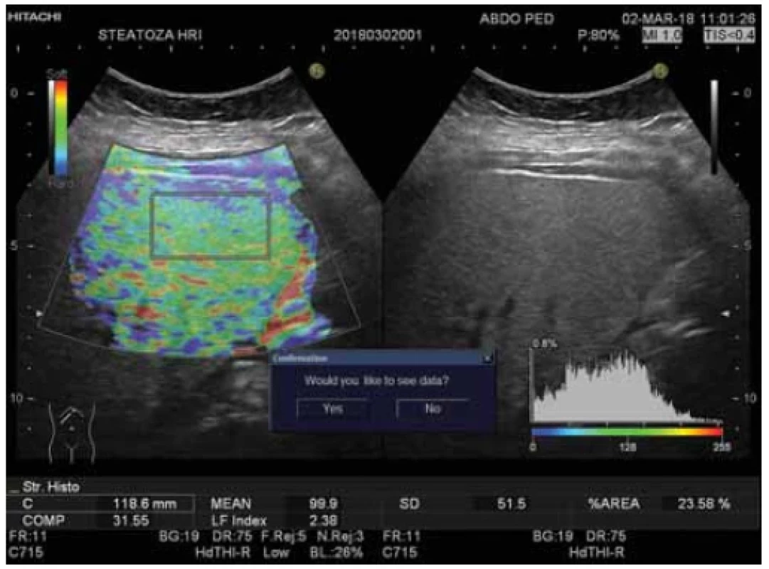 Ultrasound evaluation of liver elasticity using real-time elastography – obese
paediatric patient; LFI = 2.38 <br> .
Obr. 4. Ultrazvukové hodnotenie elasticity pečene pomocou elastografi e v reálnom čase –
obézny detský pacient; LFI = 2,38.
