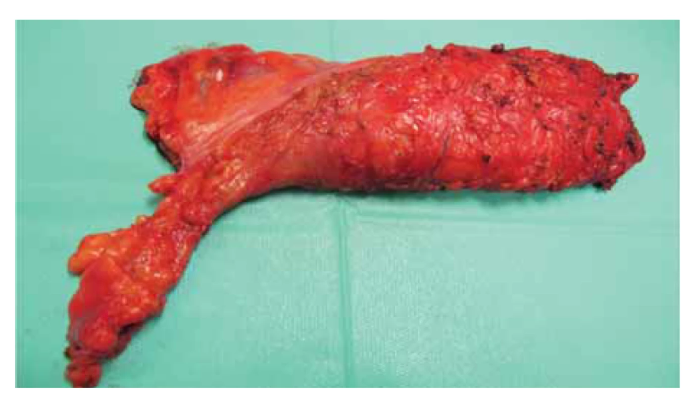 Fotografie resekátu – roboticky asistovaná resekce rekta s TME.<br>
Fig. 3. Resection photography – robotically assisted rectal resection with TME.
