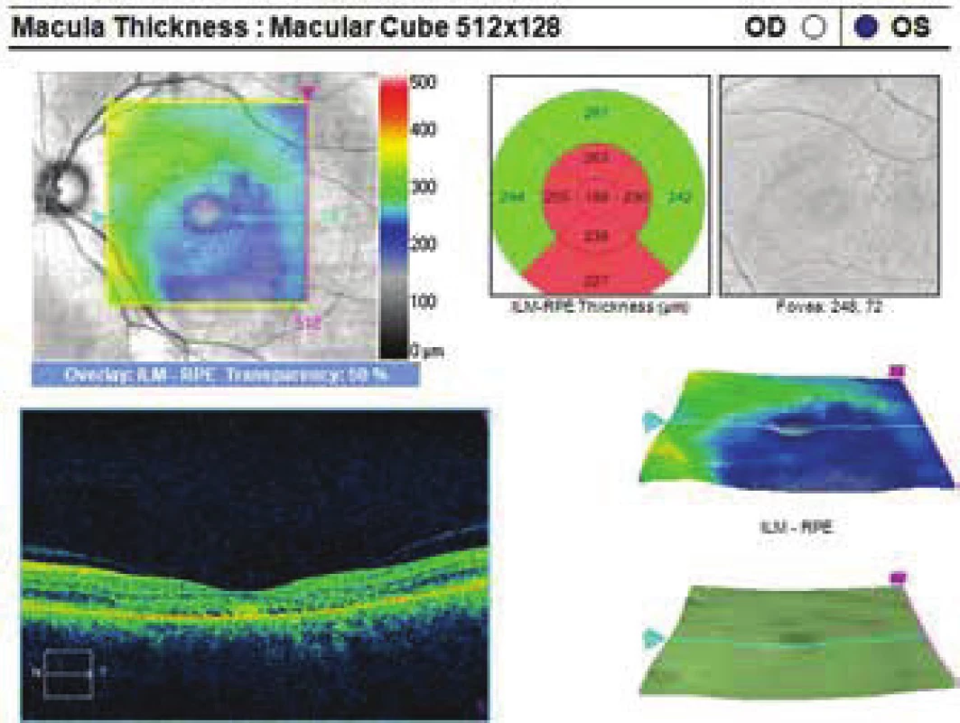 Improvement of condition after PDT, reduction of ablation
of neuroretina