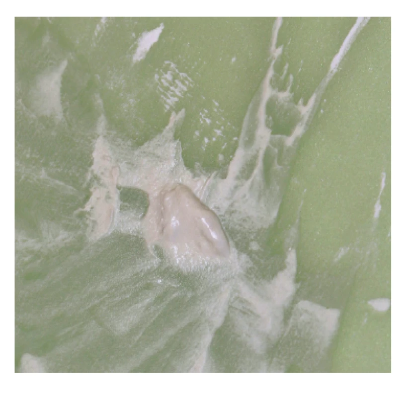 Čerstvo namiešaný<br>
biokeramický<br>
kalciumsilikátový cement<br>
ProRoot® MTA<br>
Fig. 1<br>
Freshly mixed<br>
bioceramic<br>
calcium-silicate cement<br>
ProRoot® MTA