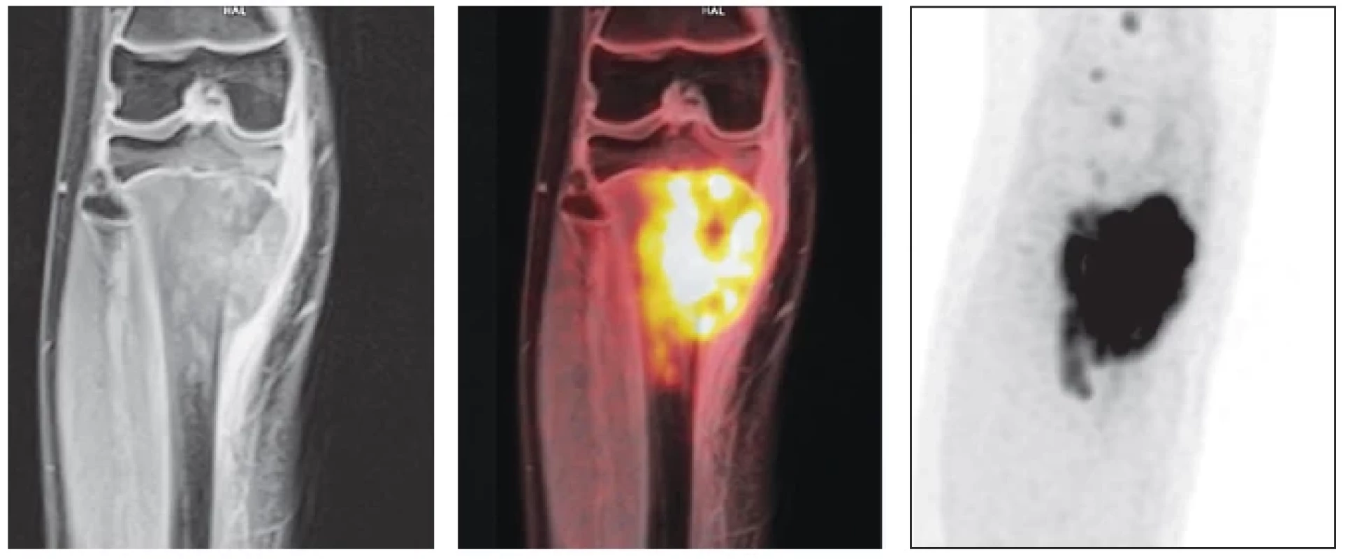 Desetiletý
chlapec
s osteogenním
sarkomem,
vyšetření s podáním
18F-FDG,
hypermetabolický
agresivní
typ nádoru, T1
VIBE ve frontální
rovině, PET/MRI
fúze, PET obraz,
kromě nádoru
patrné i uzlinové
metastázy v popliteální
krajině