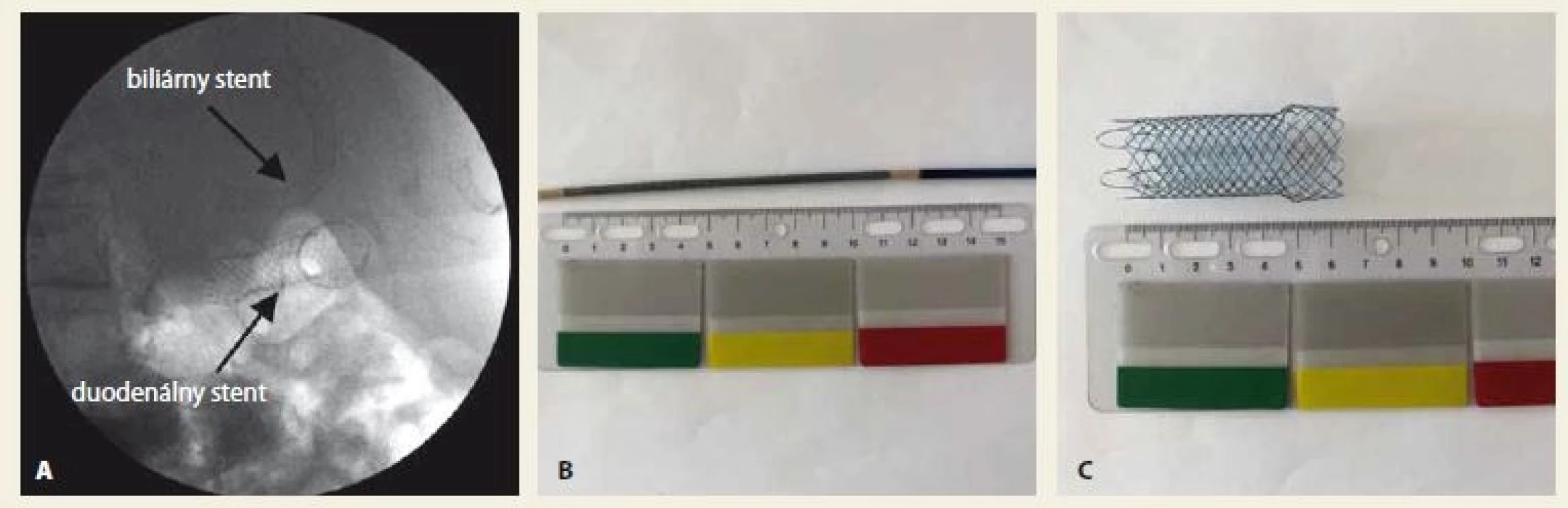 A. Implantovaný metalický duodenálny a biliárny metalický stent, B. metalický stent (nekrytý, duodenálny
20 × 66 mm, Boston Scientific) v zavádzači, C. metalický stent po vysunutí. Zdroj: Archív FN Trnava.<br>
Fig. 1. A. Implanted duodenal and biliary metal stent, B. metal stent (uncovered, duodenal 20 × 66 mm, Boston Scientific) in
the introducer, C. metal stent after ejection. Source: Archive FN Ostrava.