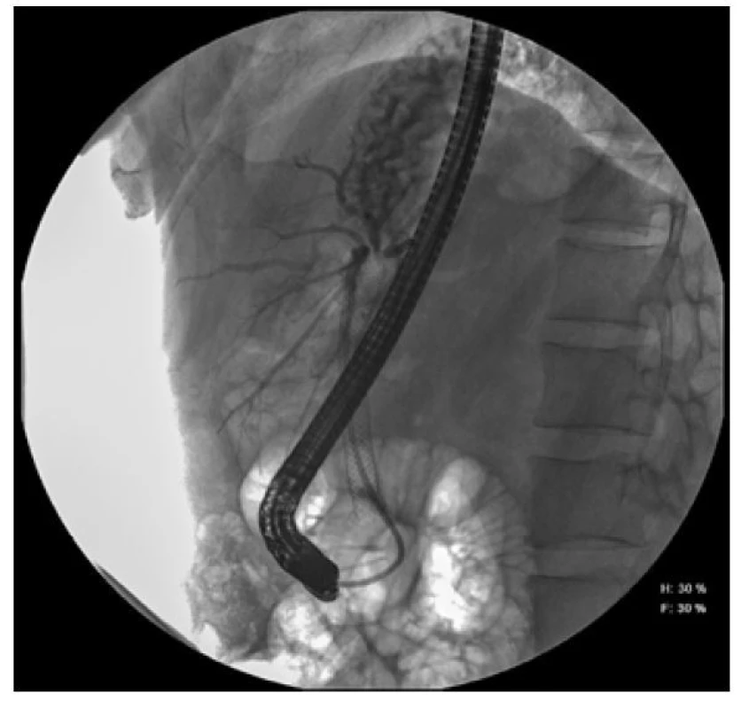 ERCP snímek choledochu našeho pacientu se zavedeným metalickým
stentem