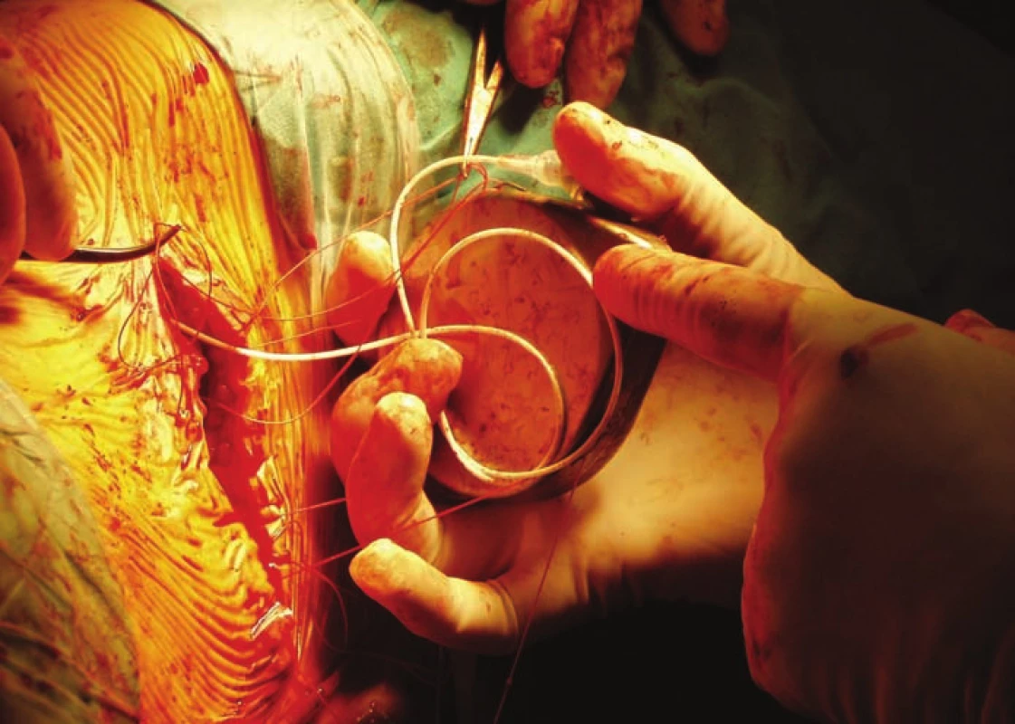 Implantácia baklofénovej pumpy – napojenie tunelizovaného katétra na pumpu,
ktorá je následne vložená do podkožia.<br>
Fig. 3. Baclofen pump implantation – catheter is tunneled and connected to the pump,
which is placed into the sack under the skin of the abdomen.