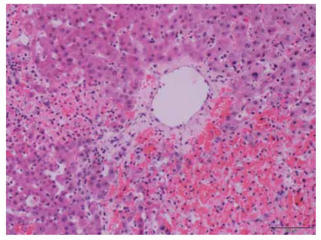 Detail nekrózy jater situované v okolí centrální vény.<br>
Fig. 3. Detail of liver necrosis situated around the central vein.