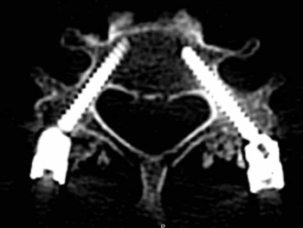 Anatomicky správné zavedení pedikulárních šroubů v C6 (stupeň 0 dle Laercha) <br>
Fig. 2: The anatomically correct position of C6 pedicle screws (Laerch grade 0) 