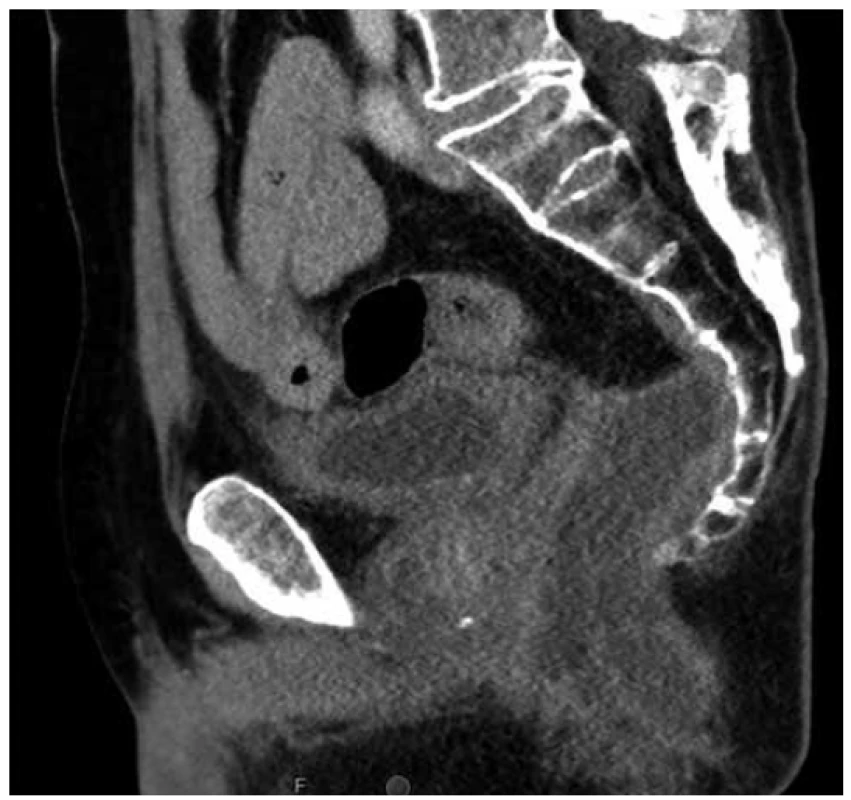 Sagitální řez CT pánve s presakrální abscesovou
formací po amputaci rekta<br>
Fig. 2. Sagittal pelvic CT scan with presacral abscess after
abdominoperineal resection