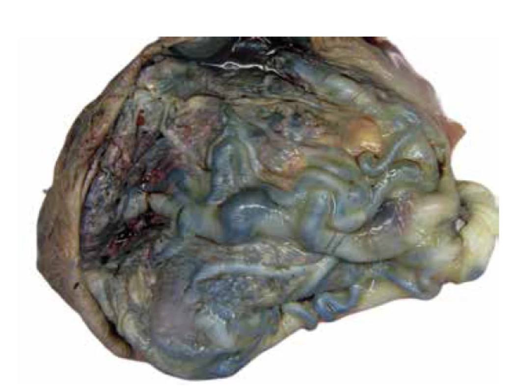 PMD. Objemná placenta (640 g; gr.h. 40+0) s výrazně dilatovanými
cévami choriové plotny.