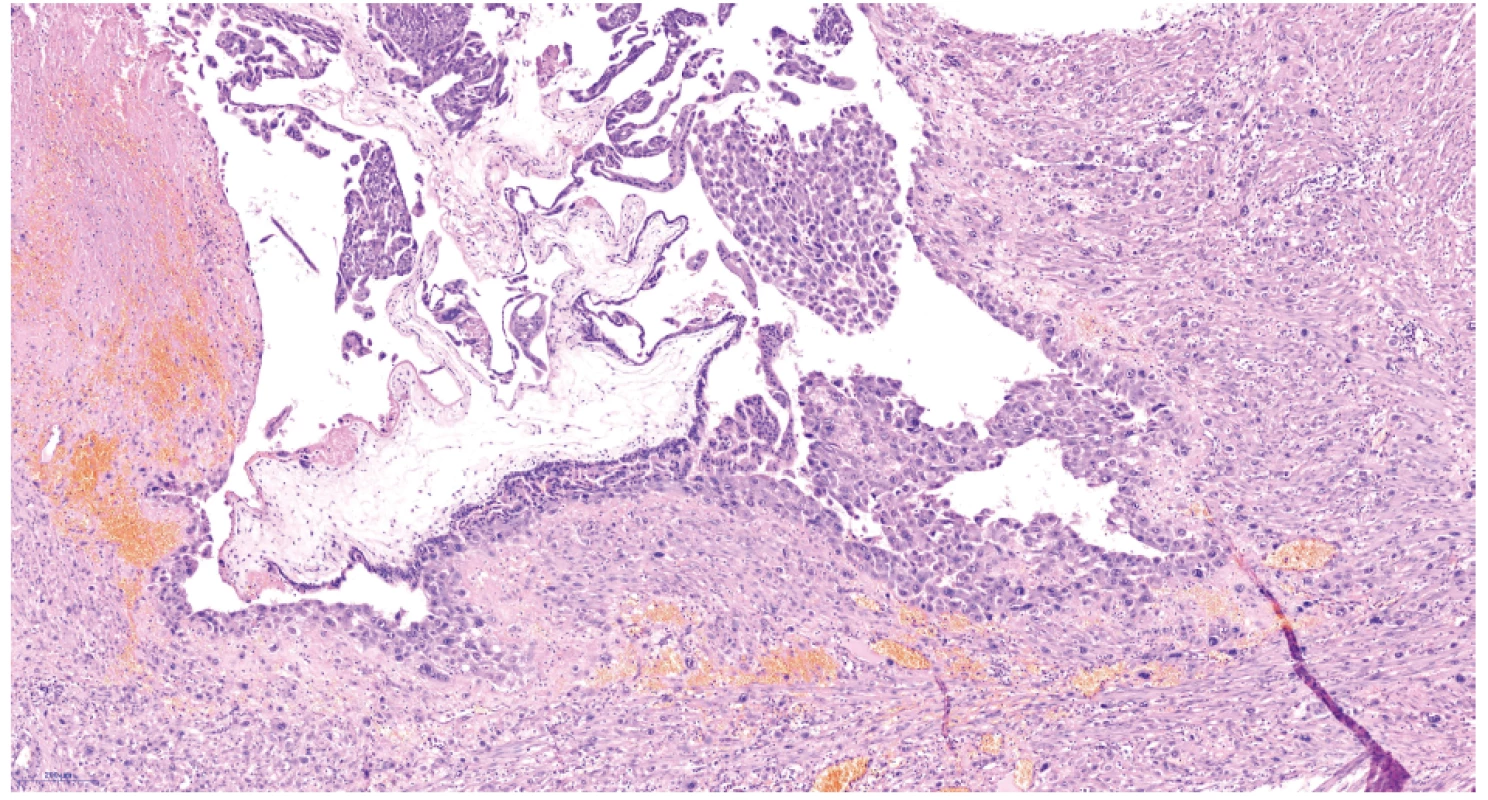 Choriový klk s proliferujícím trofoblastem – hematoxylin eozin