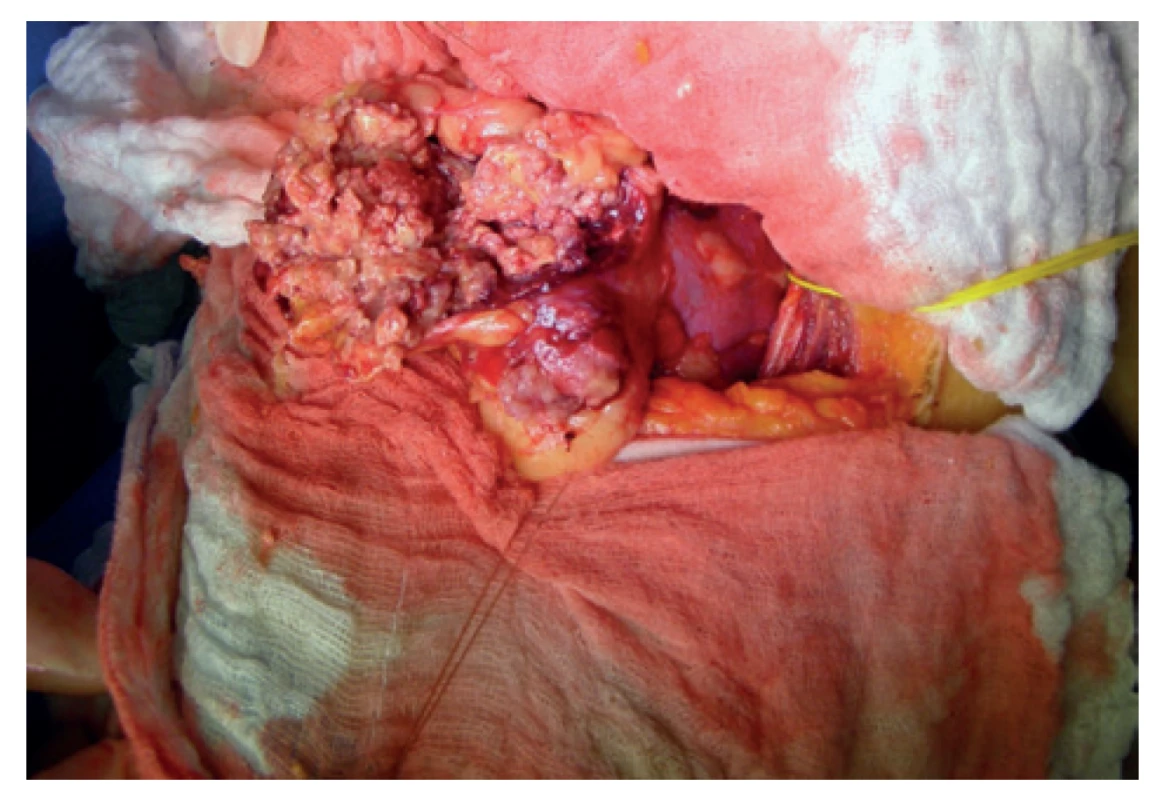 Embolizovaný angiomyolipom pravé ledviny
(archiv autora)<br>
Fig. 3: The embolized right-sided renal angiomyolipoma
(author´s archive)