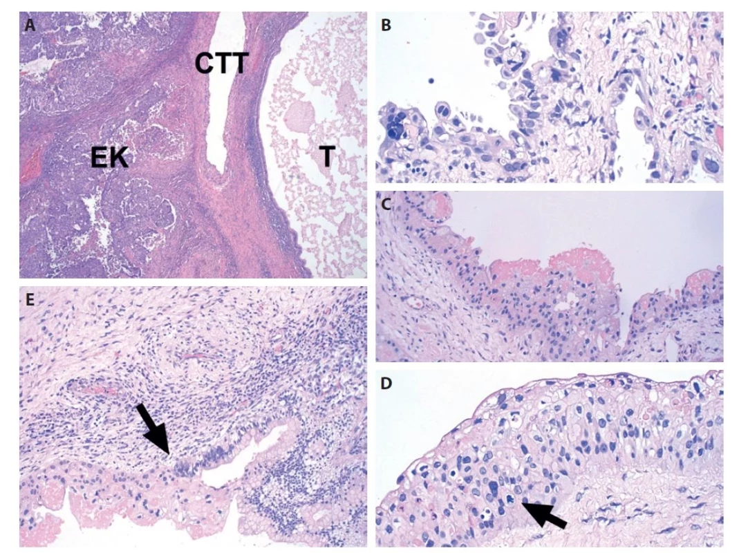 Histomorfologické charakteristiky CTT; A - zmiešaný germinatívny nádor so zastúpením teratómu (T), embryonálneho karcinómu (EK)
a cystického trofoblastického tumoru (CTT) (farbenie H&E; zväčšenie x40); B - detail na cytologické charakteristiky CTT (farbenie H&E; zväčšenie
x400); C - fibrinoidné hmoty (farbenie H&E; zväčšenie x200); D - viacradé usporiadanie nádorových buniek, šípkou označená mitóza (farbenie
H&E; zväčšenie x400); E - priamy prechod (šípka) štruktúr CTT do teratómu zastúpeného cylindrickým epitelom (farbenie H&E; zväčšenie x200).