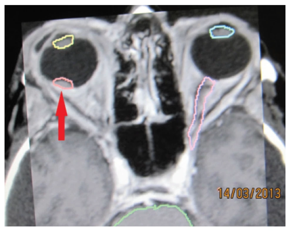 Tumour deposit – melanoma of the choroidea in
stage T1 – indicated in proximity of macula before stereotactic
irradiation in 2013 – red arrow.
