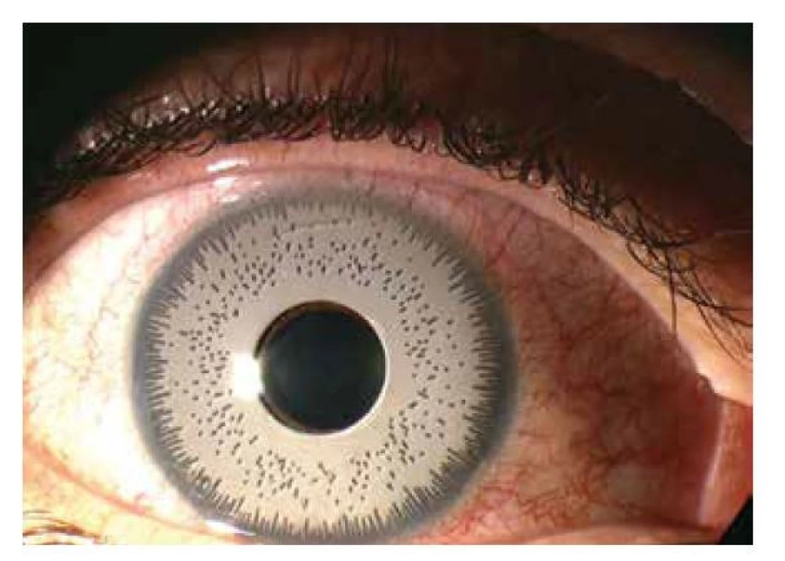 Snímek předního segmentu pravého oka znázorňující
arteficiální kosmetickou duhovku BrightOcular® (Stellar
Devices, New York, USA)