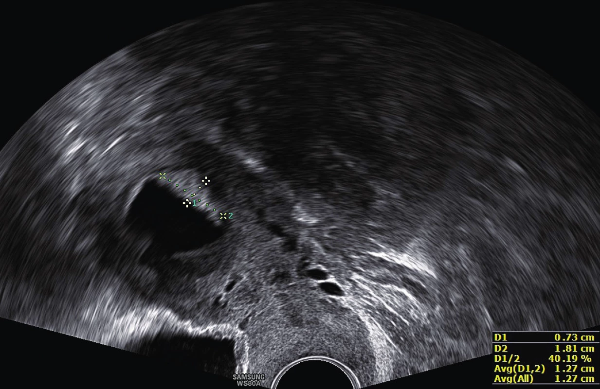 Hyperechogenní nepravidelné ložisko, fluidometra a hematometra – suspektní
