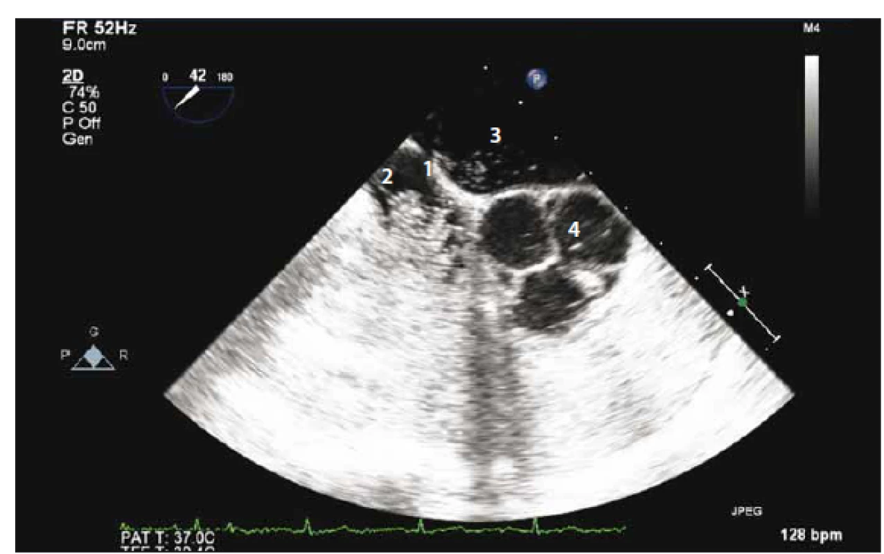 Sonografický průkaz zkratu pomocí pozitivního echokontrastu – 1. septum síní;
2. pravá síň z větší část vyplněná echo kontrastem; 3. levá síň; 4. aortální chlopeň trojcípá.<br>
Fig. 1. Sonographically prooved shunt by contrast echocardiography – 1. interatrial septum;
2. right atrium mostly filled with echo contrast; 3. left atrium; 4. tricommissural aortic
valve.