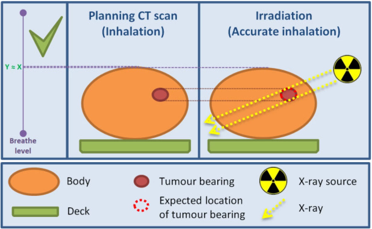 Irradiation process with breathing control via visual feedback.