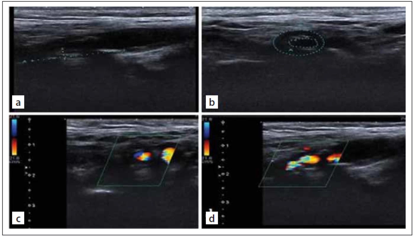 Internal carotid artery imaging. Gray-scale US images of severe (80%) internal
carotid artery stenosis (a, b). Colour Doppler US images of severe (80%) internal
carotid artery stenosis (c, d).<br>
Obr. 1. Zobrazování vnitřní karotidy. UZ zobrazení stupnice šedi těžké (80%) stenózy
vnitřní karotidy (a, b). Barevné dopplerovské UZ zobrazení těžké (80%) stenózy vnitřní
karotidy (c, d).