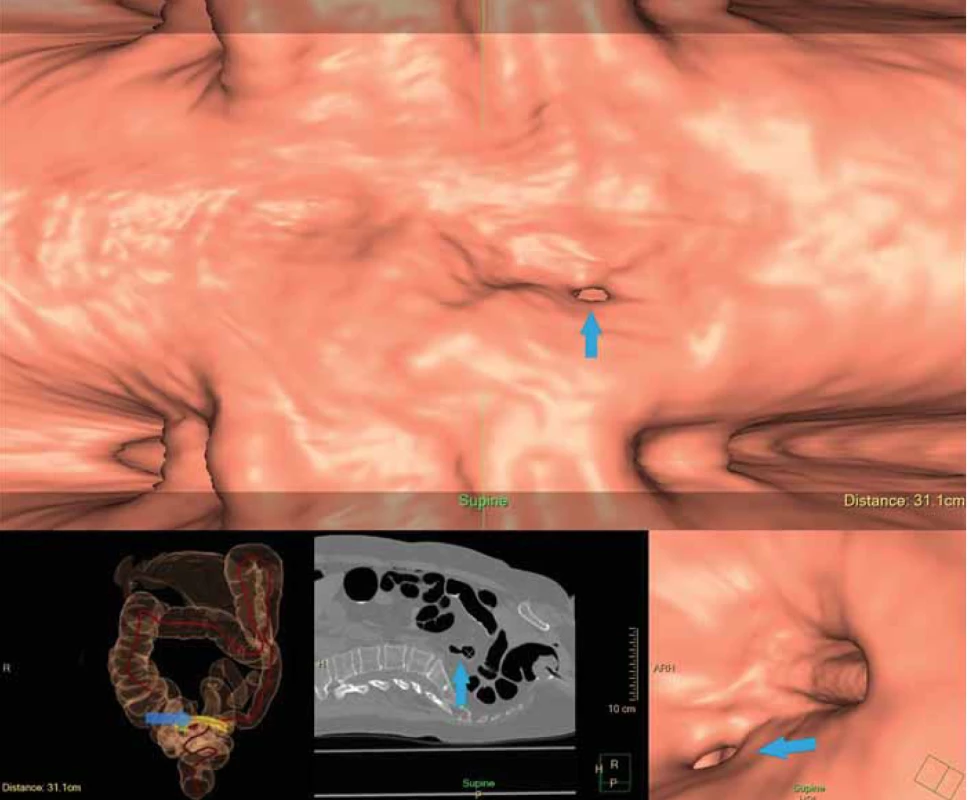 Obrázek divertiklu (šipka) v 3D zobrazení. <br>
Fig. 3. Picture of diverticulum (arrow) in 3D reconstruction.