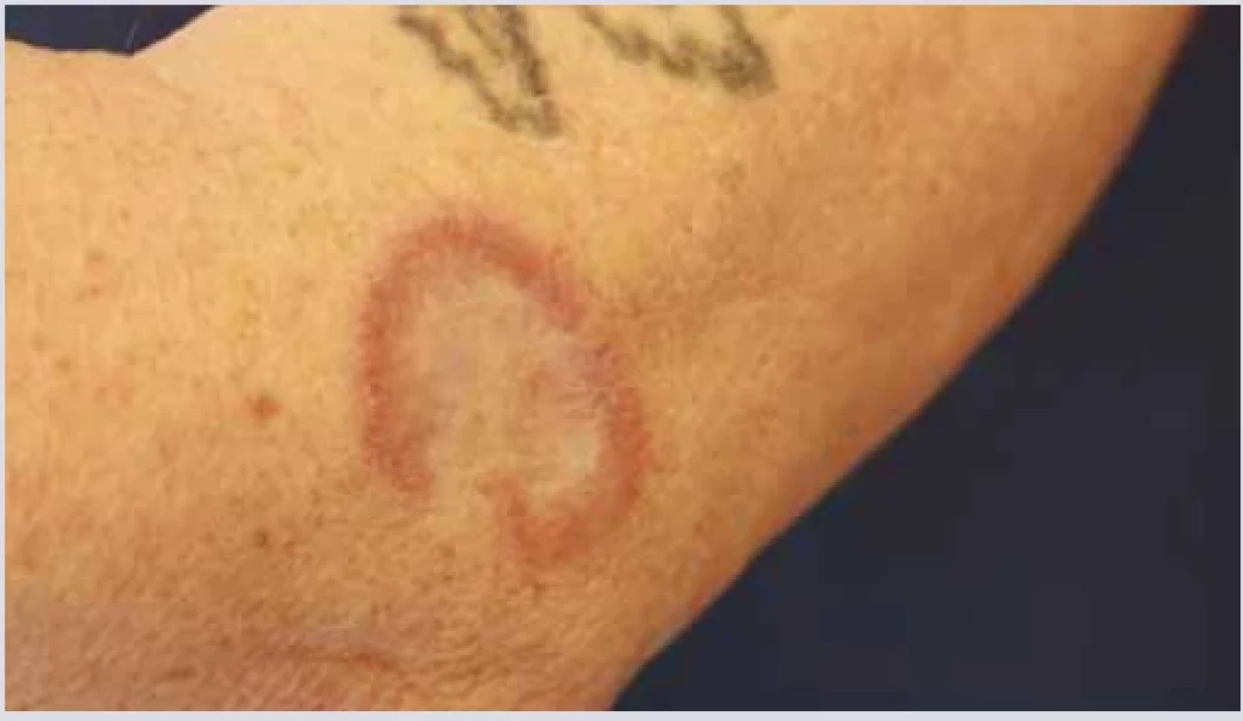 Granuloma annulare. <br> 
Fig. 10. Granuloma annulare.