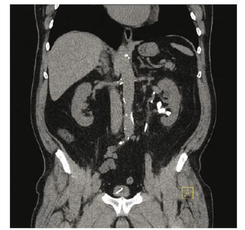 Reziduálna litiáza k RIRS l. sin. – cca 3 mesiace
po laparoskopickej intervencii (RIRS – retrograde
intrarenal surgery)<br>
Fig. 5. Residual stones indicated to RIRS l. sin. – aprox.
3 month after laparoscopic surgery