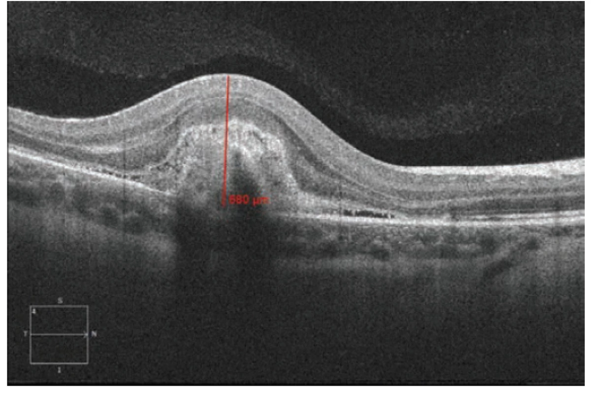 Spectral HD OCT: Linear horizontal transfoveolar scan of right
eye. Significant thickening and increase of volume of macular area,
active CNV with medium reflectivity, flat serous ablation of sensory
epithelium around. Thickness of juxtafoveolar area 680 μm at the
time of diagnosis