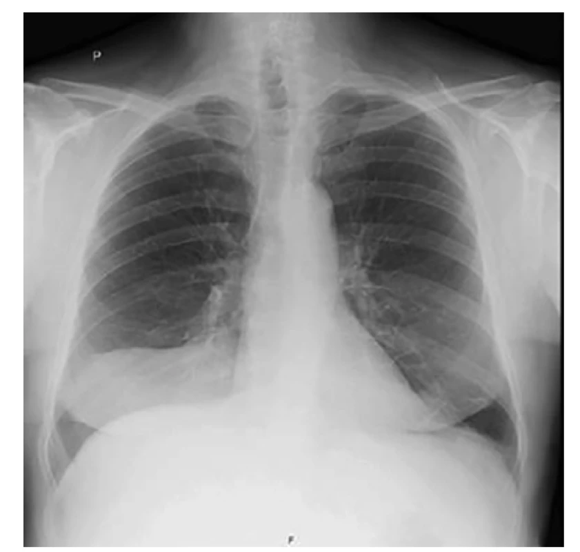 Vstupní skiagram hrudníku s patrným zastření
vpravo<br>
Fig. 1. Chest radiograph on admission with opacification
on the right side