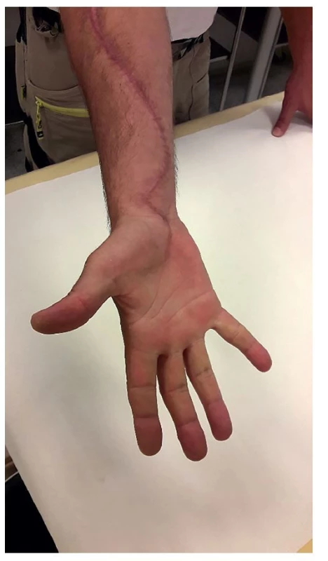 Tři měsíce od operace<br>
Fig. 10: Three months after the operation