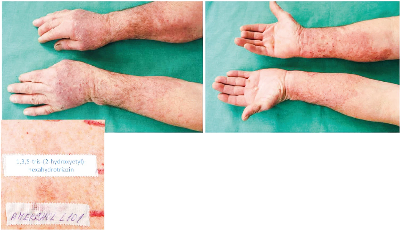 Eczema contactum prof. – 1,3,5-tris(2-hydroxyetyl)-hexahydrotriazin 1%+++, Amerchol
L101++ (průmyslové kapaliny), nikl+, benzalkonium chlorid+++, kokamidopropylbetain++, extr.
Chamomillae+++ (kosmetické přípravky), rtuť++ – obráběč kovů a dělník v galvanovně