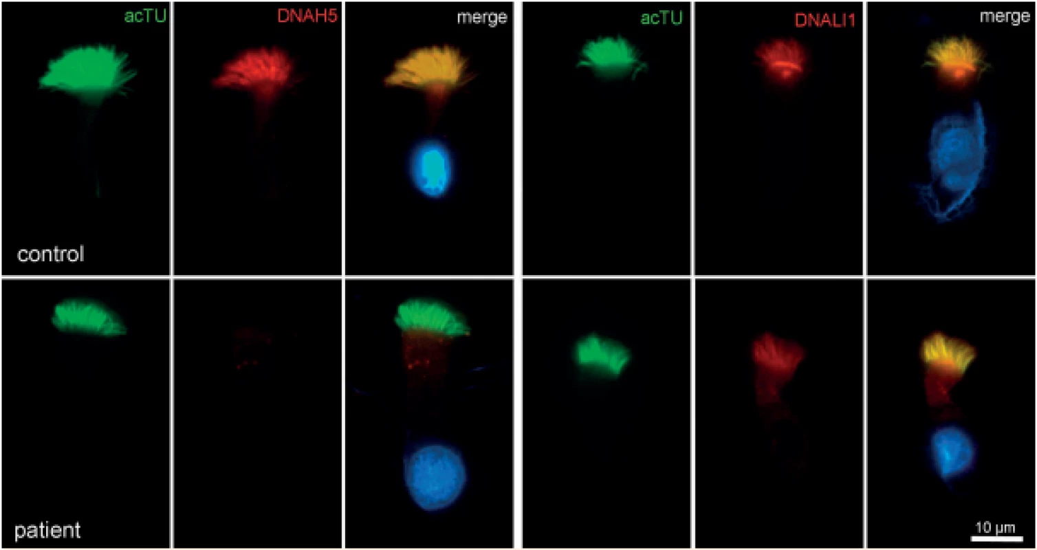 Imunofluorescence – průkaz deficitu zevních dyneinových ramének (ODA) (DNAH5 – marker zevních dyneinových ramének).<br>
Fig. 4. Immunofluorescence – outer dynein arms defect (ODA) (DNAH5 – marker of outer dynein arms).