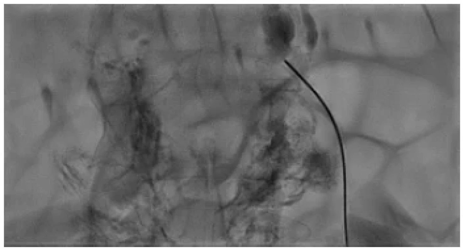 Punkce cisterna chyli Chiba jehlou <br> 
Fig. 4. Cisterna chyli puncture with a Chiba needle
